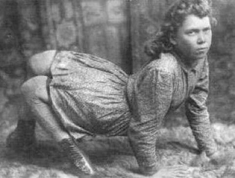 Milyonda bir görülen hastalıklar 25