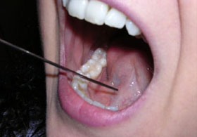 "Beta" mikrobu öldürücü olabilir