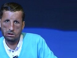 Uğur Acar'a yapılan yüz naklinin bedeli