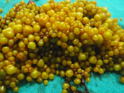 Safra kesesinden 2 bin 935 taş çıktı