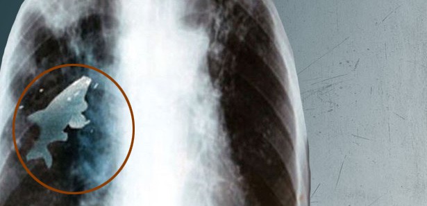 Akciğerdeki canlı balık şok etti