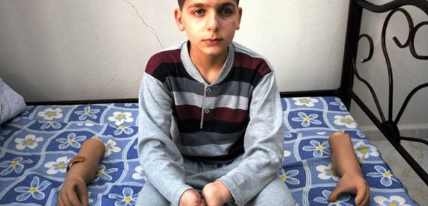 Esed'in bombaları iki elini ve sol gözünü aldı