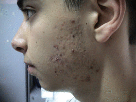 Gençlik çağındaki sivilceleri hafife almayın!