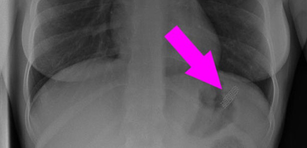 Yuttuğu cismi duyunca çok şaşıracaksınız!