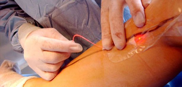 Lazerle damar tedavileri