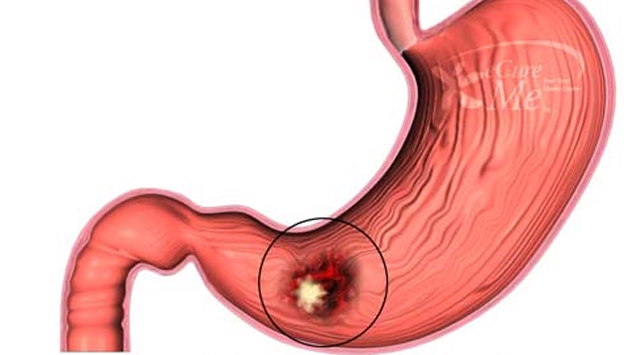 Gençlerde de görülüyor