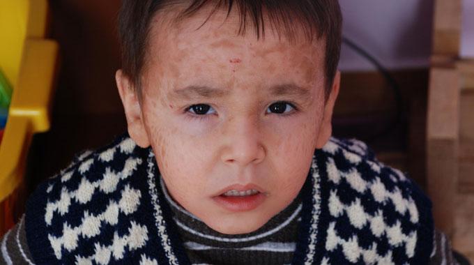 Yılan derili çocuklara teşhis konulamıyor