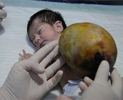 Organları kesesinde doğdu