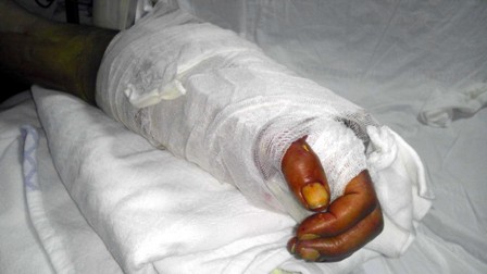 Bilek sülük tedavisiyle kurtarıldı