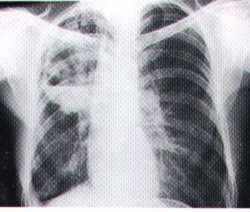 Kulu'da tüberküloz bilgilendirme toplantısı