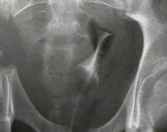 Bu kemiğin kırılması öldürebilir