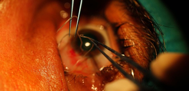 Gözünden solucan çıktı!