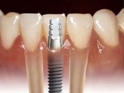 İmplantta lazer avantajı