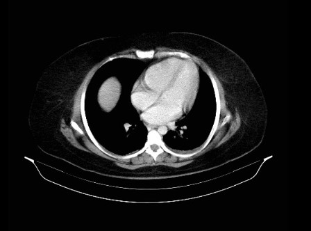 Karnından 10 santimetre kist çıktı
