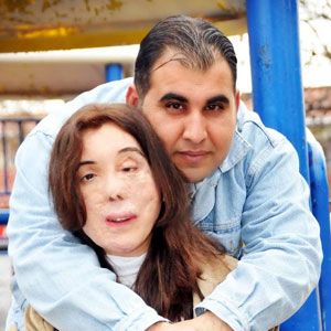 Yüz nakli bekleyen Dilek evleniyor