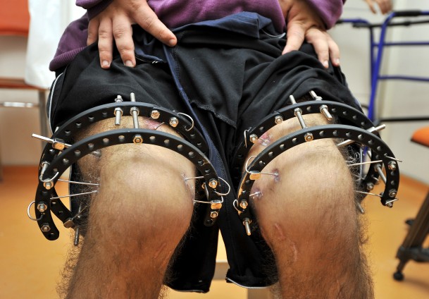 Kemik tedavisinde yeni buluş