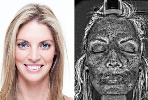 14 yıl solaryumun korkunç sonucu