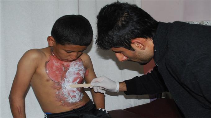 Arkadaşını benzinle yaktı