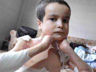 İki kardeş mum gibi eriyor