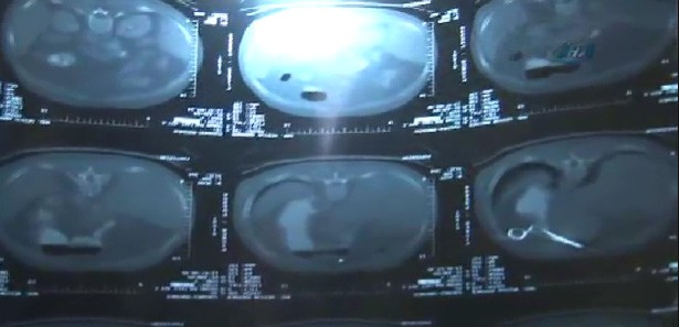 Belindeki makası 13 yıl sonra farkettiler