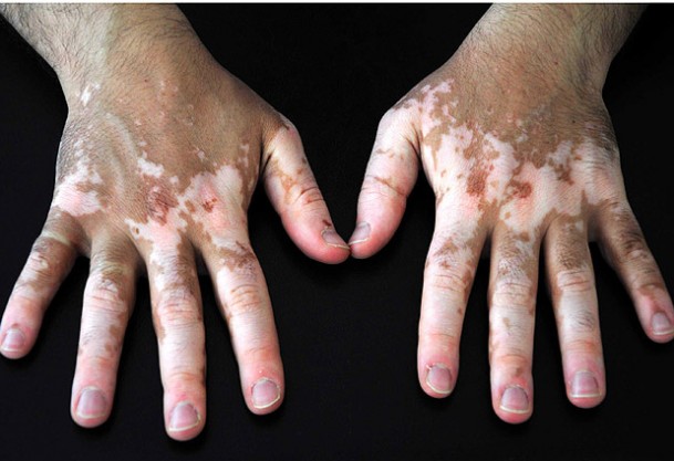 Vitiligo tedavisinde umut ışığı