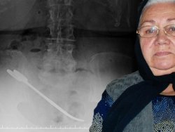 Ameliyatta makası karnında unuttular