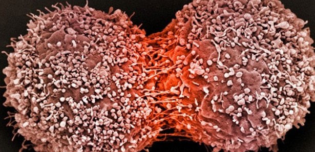 Pankreas kanserine 'Akıllı İlaç'lı çözüm