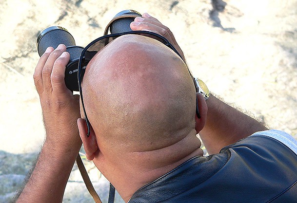 Kellik, kalp hastalıklarının habercisi olabilir