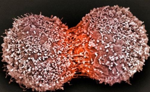 Türk Bilim Adamının Mikroçiple Kanser Teşhisi Çalışması