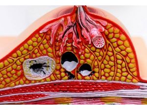 Meme kanserinde risk faktörleri 