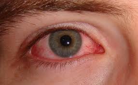 Konjonktivit Nedir?