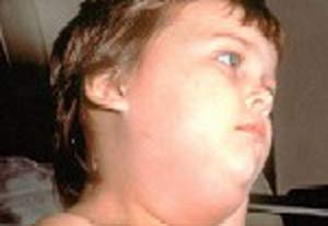 İlköğretim okulunda kabakulak salgını