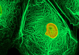 Kanser teşhisinde yeni yöntem keşfedildi