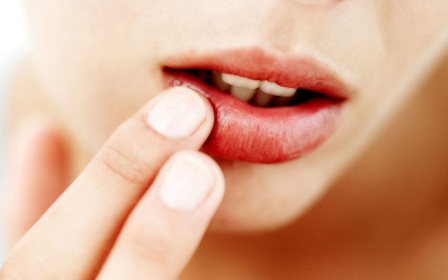 Uçuk çıkınca ne yapılmalı