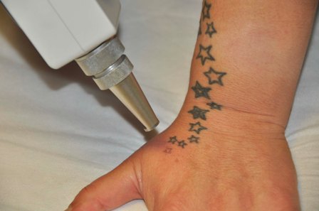 Dövmeler lazerle siliniyor