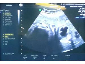 Anne karnındaki bebeğe böbrek ameliyatı