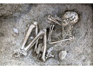 Kanser 3200 yıl önce de vardı