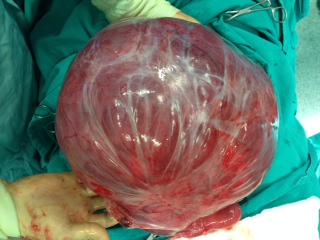 Karnından 12 kilogram kitle çıkarıldı