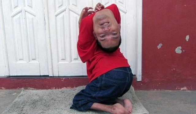 Brezilya'da boynu ters doğan adam 37 yaşında