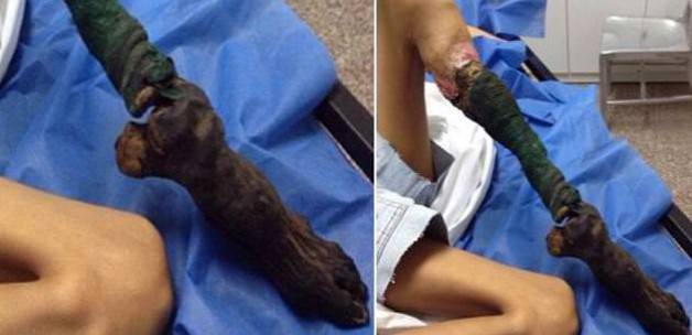 Yılan ısırığı bu hale getirdi