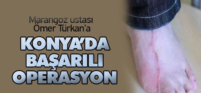 Ayak Parmağı Eline Nakledildi