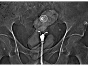 Uyuşturucuyu midesinde taşıyordu