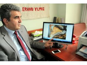 Bacaklarını Kaybetme Tehlikesi Geçiren Genç Yeniden Adım Attı