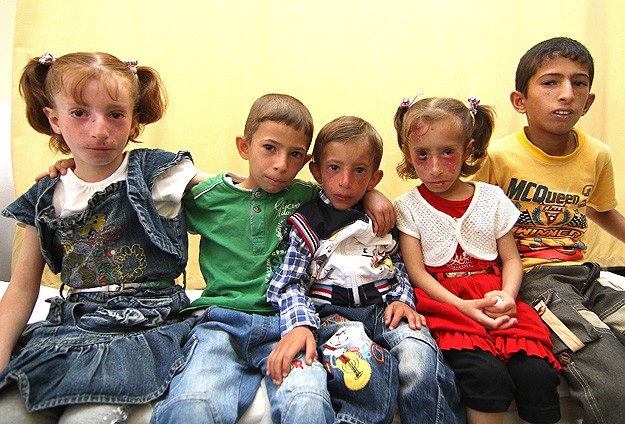 Suriyeli 6 Kuzen Aynı Hastalıkla Mücadele Ediyor