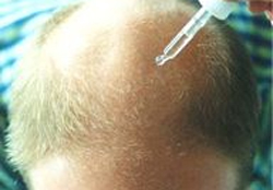 Berberin KELLİĞE ilginç çözümü