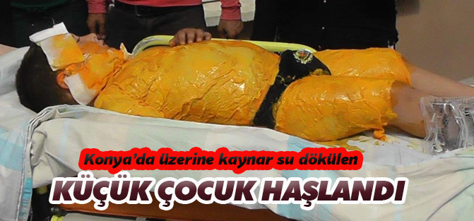 Konya'da üzerine kaynar su dökülen çocuk haşlandı
