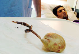 27 cm'lik tel 10 yıl sonra fark edildi