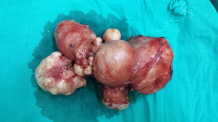 Meram Tıptan başarılı kapalı yöntem rahim alma ameliyatı