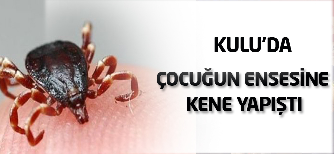 Kulu'da çocuğun ensesine kene yapıştı