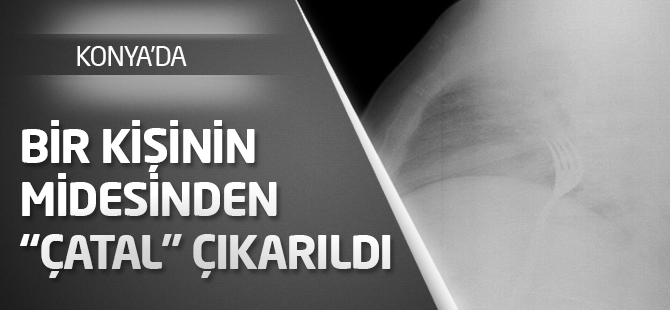 Midesinden "çatal" çıkarıldı